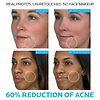La Roche-Posay Duo Dual Action Acne Spot Treatment with Benzoyl Peroxide-3
